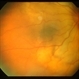 Metastatic Breast Cancer